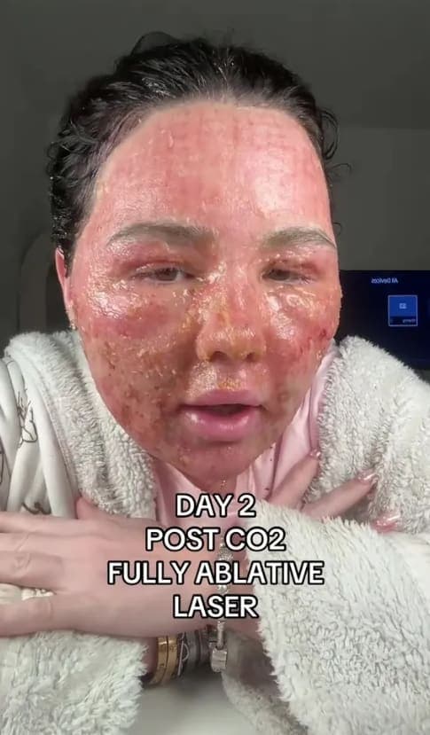 Stevie nhận ra rằng da mặt mình 'rất cứng' và 'có những lớp vảy bong ra'. Ảnh: tiktok/@steviethatautisticbaddie